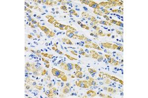 Immunohistochemistry of paraffin-embedded human liver cancer using SLC16A4 antibody. (SLC16A4 抗体)
