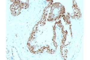 Formalin-fixed, paraffin-embedded human Prostate Carcinoma stained with p57 Mouse Monoclonal Antibody (KIP2/880). (CDKN1C 抗体)