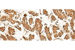 Immunohistochemistry of paraffin-embedded Human gastric cancer tissue using ZBTB43 Polyclonal Antibody at dilution of 1:40(x200) (ZBTB43 抗体)