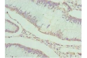 Immunohistochemistry of paraffin-embedded human colon cancer using ABIN7166867 at dilution of 1:100 (PDXK 抗体  (AA 1-312))