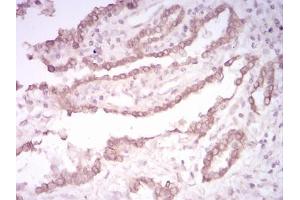 Immunohistochemical analysis of paraffin-embedded lung cancer tissues using CK5 mouse mAb with DAB staining. (Cytokeratin 5 抗体  (AA 258-357))