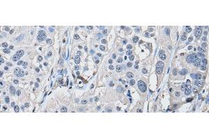 Immunohistochemistry of paraffin-embedded Human esophagus cancer tissue using PRKAR2A Polyclonal Antibody at dilution of 1:50(x200) (PRKAR2A 抗体)