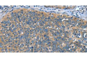 Immunohistochemistry of paraffin-embedded Human cervical cancer tissue using DTX1 Polyclonal Antibody at dilution 1:30 (Deltex Homolog 1 抗体)