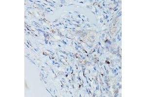 Immunohistochemistry of paraffin-embedded Human pulmonary tuberculosis using GSDME Rabbit pAb (ABIN6127757, ABIN6139554, ABIN6139555 and ABIN6223304) at dilution of 1:50 (40x lens). (Non-Syndromic Hearing Impairment Protein 5 (GSDME) (AA 1-260) 抗体)