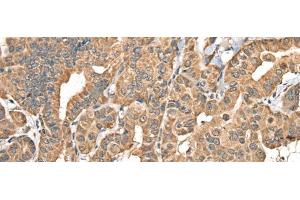 Immunohistochemistry of paraffin-embedded Human thyroid cancer tissue using NADK2 Polyclonal Antibody at dilution of 1:40(x200) (NADK2 抗体)