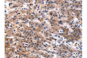 The image on the left is immunohistochemistry of paraffin-embedded Human liver cancer tissue using ABIN7128981(CNGA2 Antibody) at dilution 1/25, on the right is treated with fusion protein. (CNGA2 抗体)