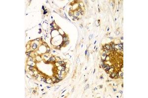Immunohistochemistry of paraffin-embedded human liver cancer using RPN1 antibody. (RPN1 抗体  (AA 20-280))