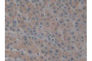 IHC-P analysis of Human Liver cancer Tissue, with DAB staining. (TAB1 抗体  (AA 189-439))