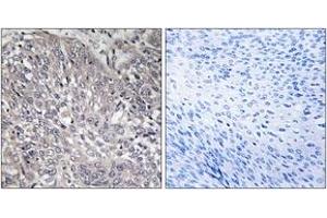 Immunohistochemistry analysis of paraffin-embedded human cervix carcinoma tissue, using InsP3R1 (Ab-1598/1588) Antibody. (ITPR1 抗体  (AA 1566-1615))