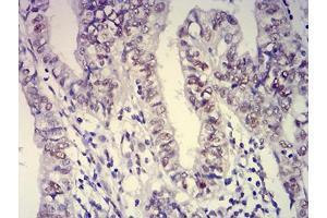 Immunohistochemical analysis of paraffin-embedded endometrial cancer tissues using ATXN1 mouse mAb with DAB staining. (Ataxin 1 抗体  (AA 645-815))