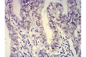 Immunohistochemical analysis of paraffin-embedded endometrial cancer tissues using ATXN1 mouse mAb with DAB staining.