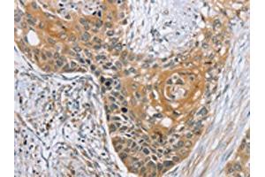The image on the left is immunohistochemistry of paraffin-embedded Human esophagus cancer tissue using ABIN7192155(RBM38 Antibody) at dilution 1/35, on the right is treated with synthetic peptide. (RBM38 抗体)