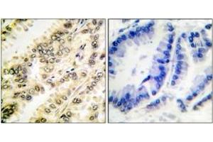 Immunohistochemistry analysis of paraffin-embedded human breast carcinoma, using SGK (Phospho-Ser422) Antibody. (SGK1 抗体  (pSer422))