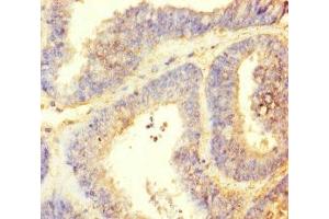 Immunohistochemistry of paraffin-embedded human endometrial cancer using ABIN7164621 at dilution of 1:100 (TTLL9 抗体  (AA 1-230))