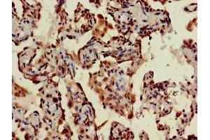 IHC image of ABIN7170794 diluted at 1:400 and staining in paraffin-embedded human lung cancer performed on a Leica BondTM system. (STING/TMEM173 抗体  (AA 207-379))