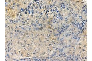 ABIN6265916 and ABIN6277797 at 1/100 staining human lung squamous cell carcinoma by IHC-P. (USP22 抗体  (Internal Region))