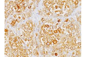 Formalin-fixed, paraffin-embedded human Melanoma stained with Melan-A Monoclonal Antibody (M2-9E3). (MLANA 抗体)