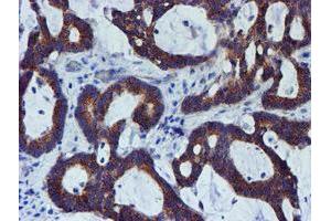 Immunohistochemical staining of paraffin-embedded Adenocarcinoma of Human colon tissue using anti-PDSS2 mouse monoclonal antibody. (PDSS2 抗体)