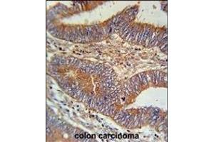 BIN2 Antibody (N-term) (ABIN651965 and ABIN2840476) immunohistochemistry analysis in formalin fixed and paraffin embedded human colon carcinoma followed by peroxidase conjugation of the secondary antibody and DAB staining. (BIN2 抗体  (N-Term))