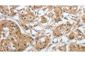 Immunohistochemistry of paraffin-embedded Human lung cancer using Amphiphysin I Polyclonal Antibody at dilution of 1:30 (Amphiphysin 抗体)