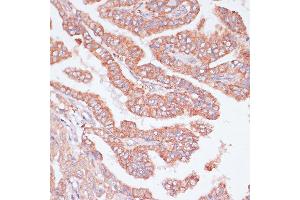Immunohistochemistry of paraffin-embedded Human thyroid cancer using CDC20 antibody (ABIN7266246) at dilution of 1:100 (40x lens). (CDC20 抗体  (AA 1-270))