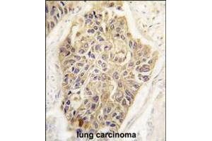 Formalin-fixed and paraffin-embedded human lung carcinoma tissue reacted with MAGEA1 Antibody , which was peroxidase-conjugated to the secondary antibody, followed by DAB staining. (MAGEA1 抗体  (AA 143-173))