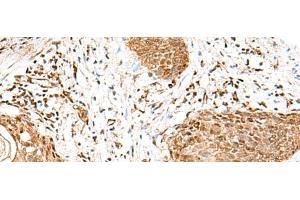 Immunohistochemistry of paraffin-embedded Human esophagus cancer tissue using GMPPB Polyclonal Antibody at dilution of 1:50(x200)