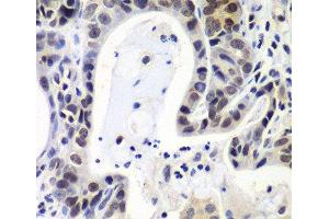 Immunohistochemistry of paraffin-embedded Human gastric cancer using LSM2 Polyclonal Antibody at dilution of 1:100 (40x lens). (LSM2 抗体)