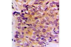 Immunohistochemical analysis of Cytokeratin 10 staining in human breast cancer formalin fixed paraffin embedded tissue section.