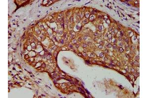 IHC image of ABIN7157412 diluted at 1:400 and staining in paraffin-embedded human cervical cancer performed on a Leica BondTM system. (Cytokeratin 1 抗体  (AA 267-438))
