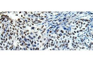 Immunohistochemistry of paraffin-embedded Human esophagus cancer tissue using DDX39A Polyclonal Antibody at dilution of 1:65(x200) (DDX39 抗体)