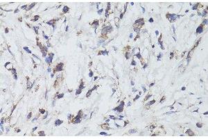 Immunohistochemistry of paraffin-embedded Human gastric cancer using TrkB Polyclonal Antibody at dilution of 1:200 (40x lens). (TRKB 抗体)