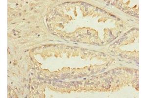 Immunohistochemistry of paraffin-embedded human prostate cancer using ABIN7157271 at dilution of 1:100 (KLHL13 抗体  (AA 1-260))