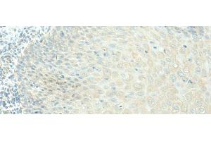 Immunohistochemistry of paraffin-embedded Human esophagus cancer tissue using EVI2B Polyclonal Antibody at dilution of 1:40(x200) (EVI2B 抗体)
