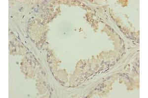 Immunohistochemistry of paraffin-embedded human prostate cancer using ABIN7175441 at dilution of 1:100