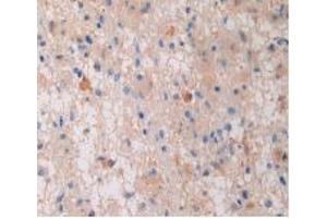 IHC-P analysis of Human Glioma Tissue, with DAB staining. (PZP 抗体  (AA 1212-1391))
