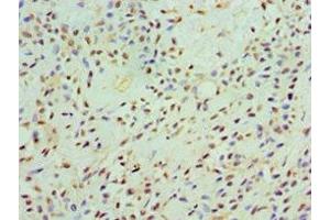 Immunohistochemistry of paraffin-embedded human breast cancer using ABIN7146438 at dilution of 1:100 (CAMK1G 抗体  (AA 217-476))
