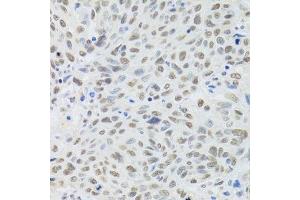 Immunohistochemistry of paraffin-embedded human lung cancer using DDB1 Antibody. (DDB1 抗体)