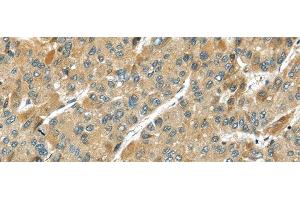Immunohistochemistry of paraffin-embedded Human liver cancer using TMPRSS11D Polyclonal Antibody at dilution of 1/35 (TMPRSS11D 抗体)