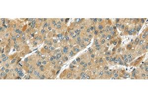 Immunohistochemistry of paraffin-embedded Human liver cancer using TMPRSS11D Polyclonal Antibody at dilution of 1/35 (TMPRSS11D 抗体)