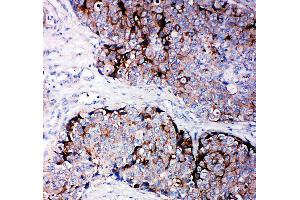 Anti-TIMP2 antibody, IHC(P) IHC(P): Human Mammary Cancer Tissue (TIMP2 抗体  (C-Term))