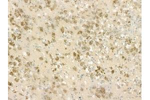 ABIN6255275 and ABIN6267125 at 1/100 staining human melanoma by IHC-P.