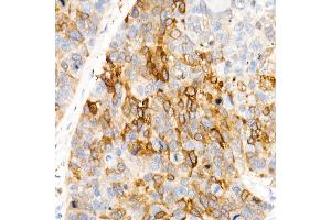 Immunohistochemistry of paraffin-embedded Human esophageal cancer using  antibody (ABIN7265531) at dilution of 400(40x lens). (ALDH1A1 抗体)