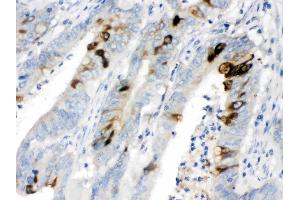 ITLN1 was detected in paraffin-embedded sections of human intestinal cancer tissues using rabbit anti- ITLN1 Antigen Affinity purified polyclonal antibody (Catalog # ) at 1 µg/mL. (ITLN1/Omentin 抗体  (N-Term))