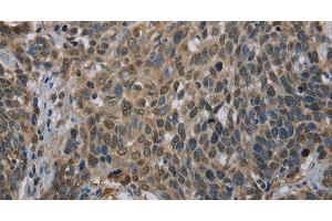 Immunohistochemistry of paraffin-embedded Human cervical cancer using UBP1 Polyclonal Antibody at dilution of 1:40 (UBP1 抗体)