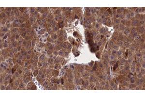 ABIN6277173 at 1/100 staining Human liver cancer tissue by IHC-P. (Selectin E/CD62e 抗体  (N-Term))