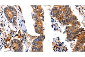 Immunohistochemistry of paraffin-embedded Human colon cancer using NCK1 Polyclonal Antibody at dilution of 1:30 (NCK1 抗体)