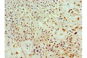 Immunohistochemistry of paraffin-embedded human breast cancer using ABIN7144280 at dilution of 1:100 (Annexin IV 抗体  (AA 110-319))