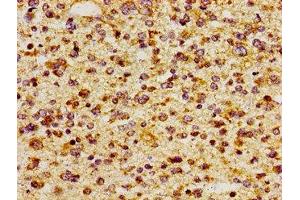 Immunohistochemistry of paraffin-embedded human glioma using ABIN7156468 at dilution of 1:100 (CD51 抗体  (AA 775-885))