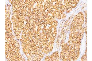 Formalin-fixed, paraffin-embedded human Renal Cell Carcinoma stained with RCC Monoclonal Antibody (SPM487). (CA9 抗体)